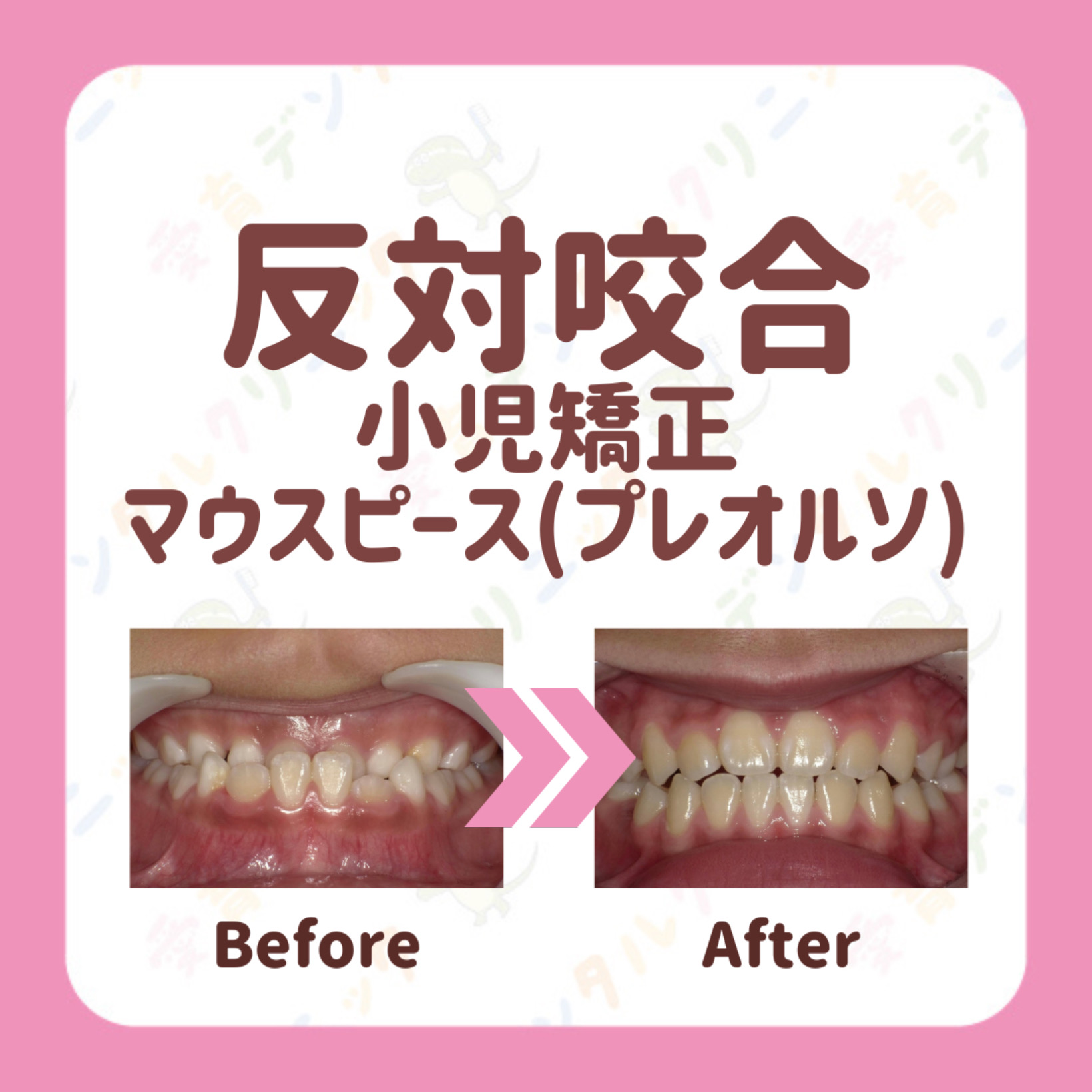 矯正症例