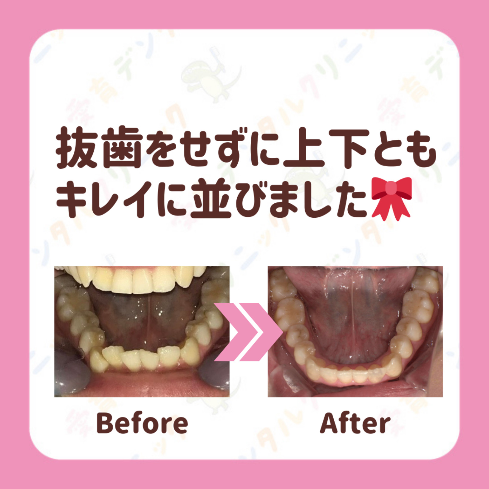 矯正症例