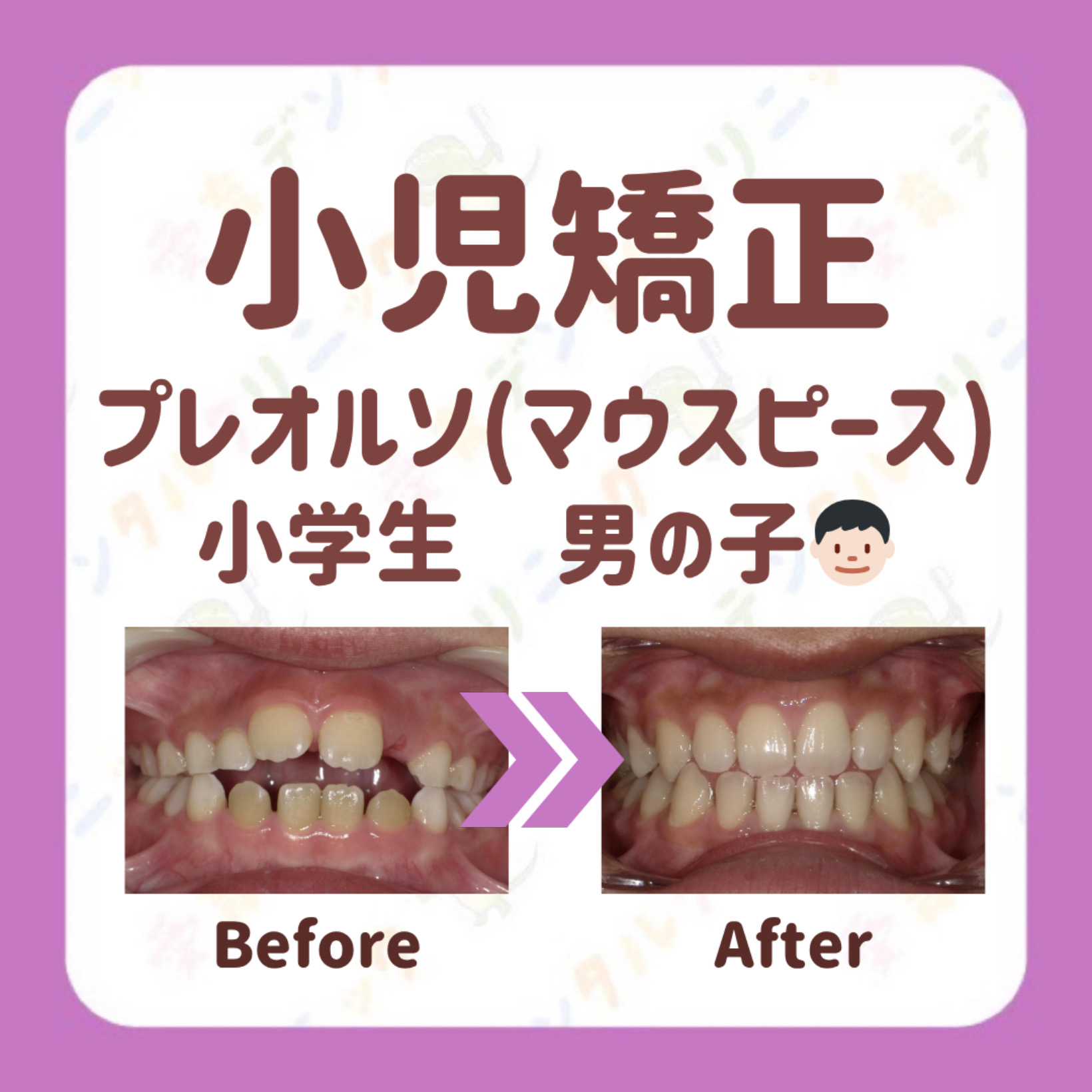 矯正症例
