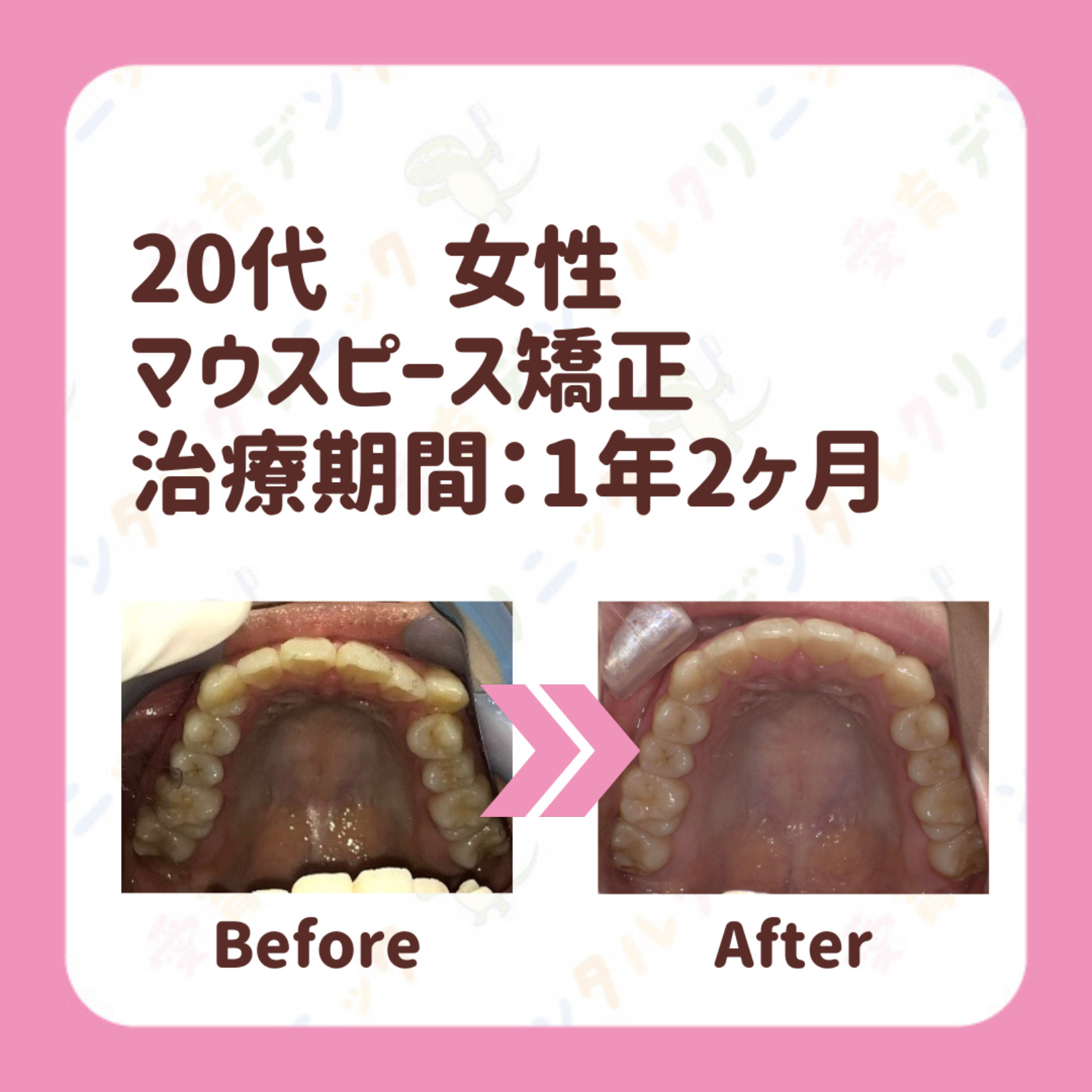 矯正症例
