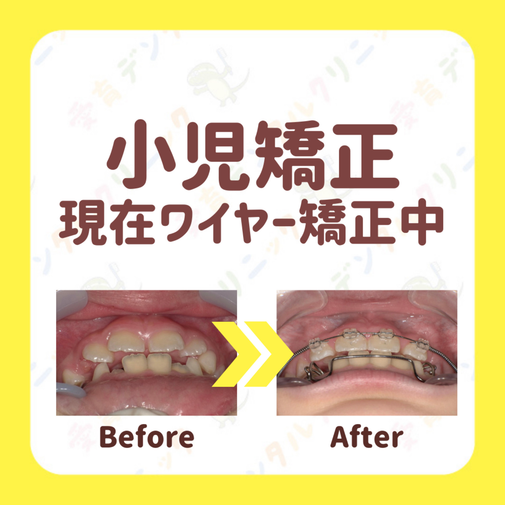 矯正症例