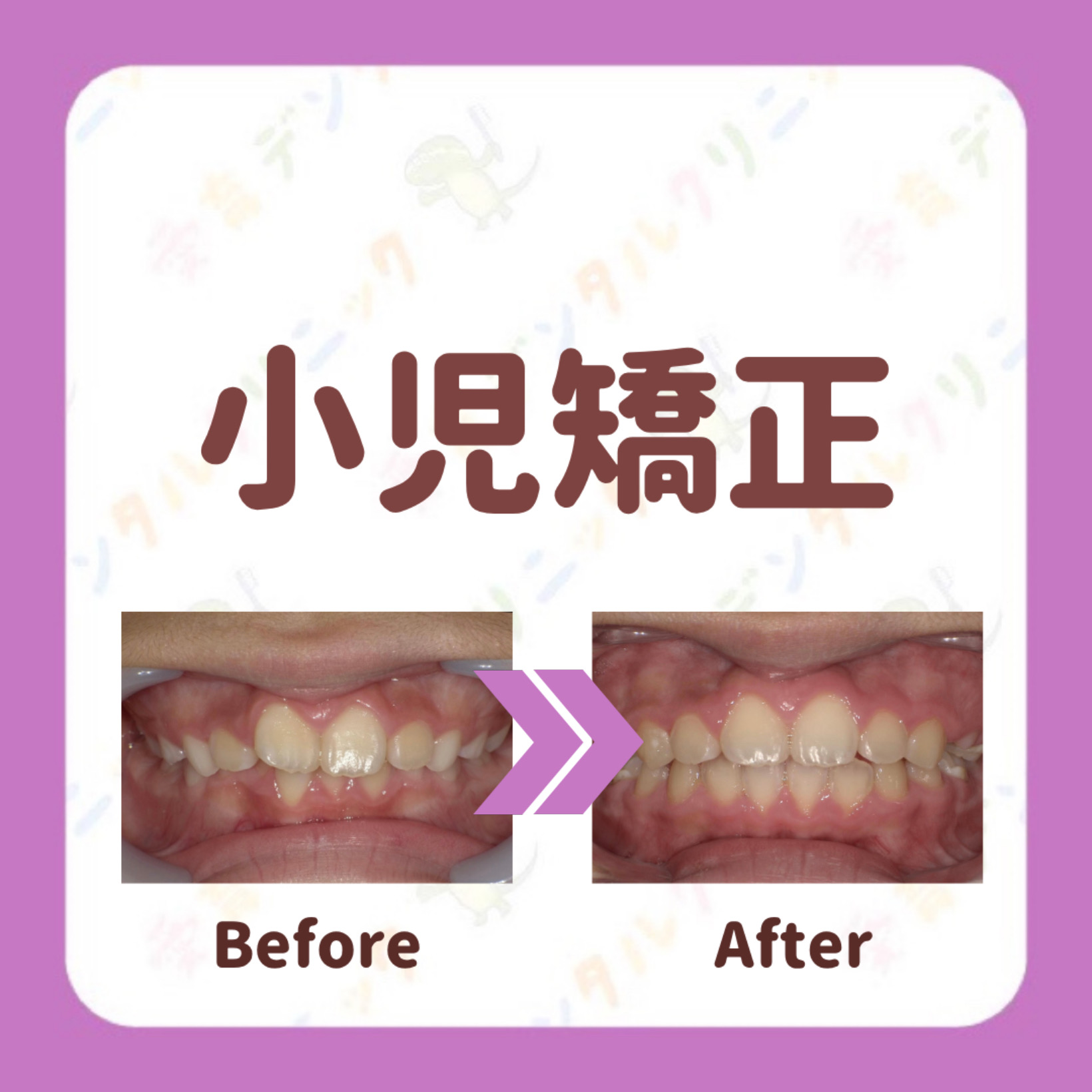 矯正症例