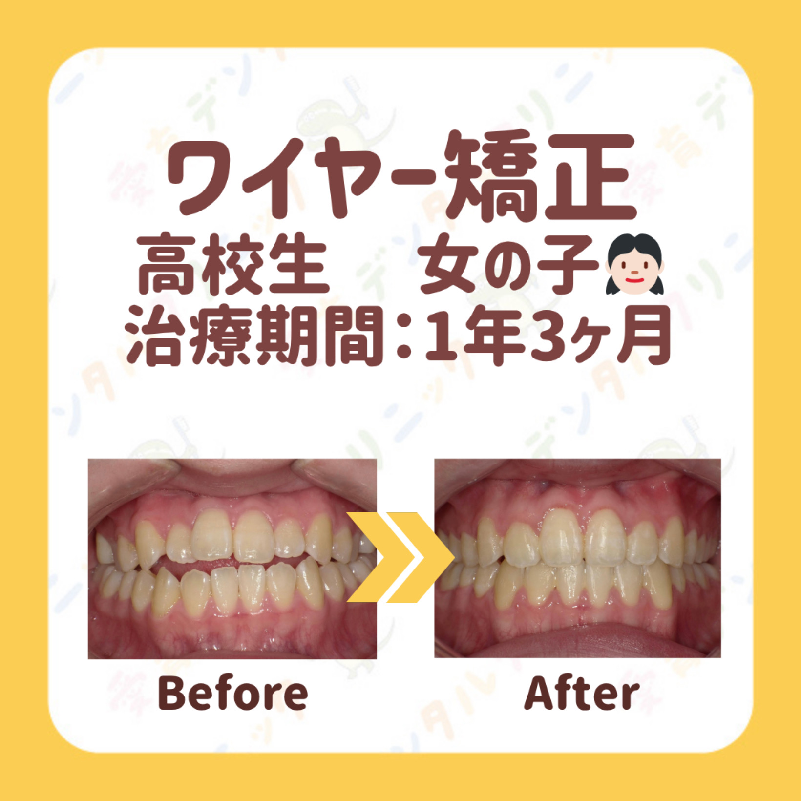 矯正症例