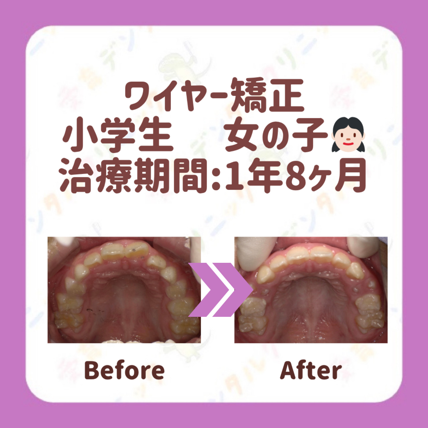 矯正症例