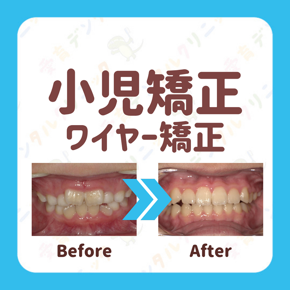 矯正症例