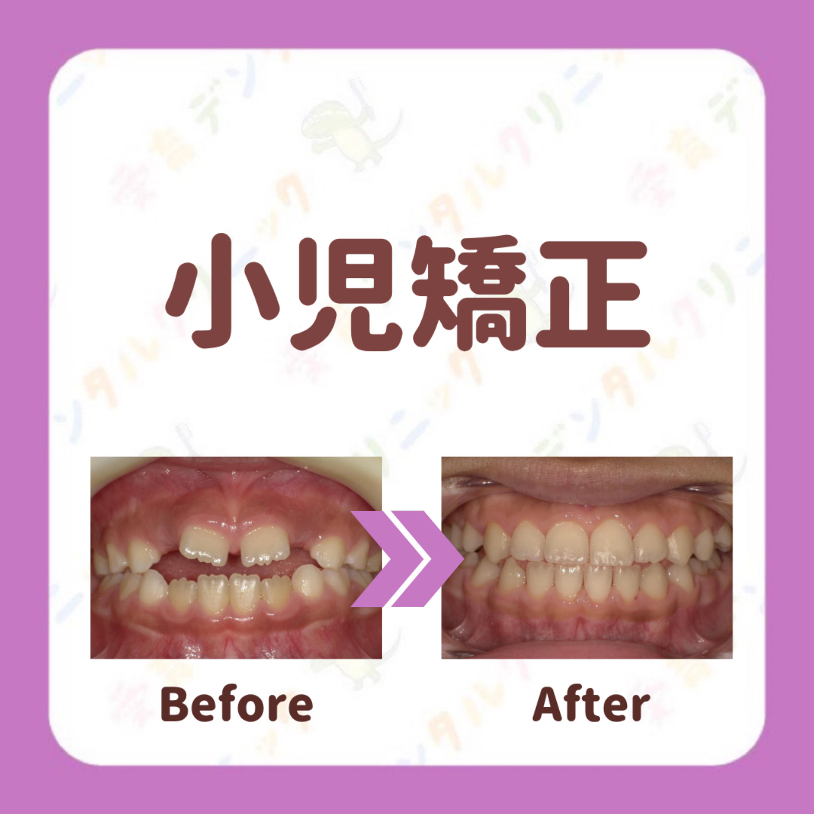 矯正症例