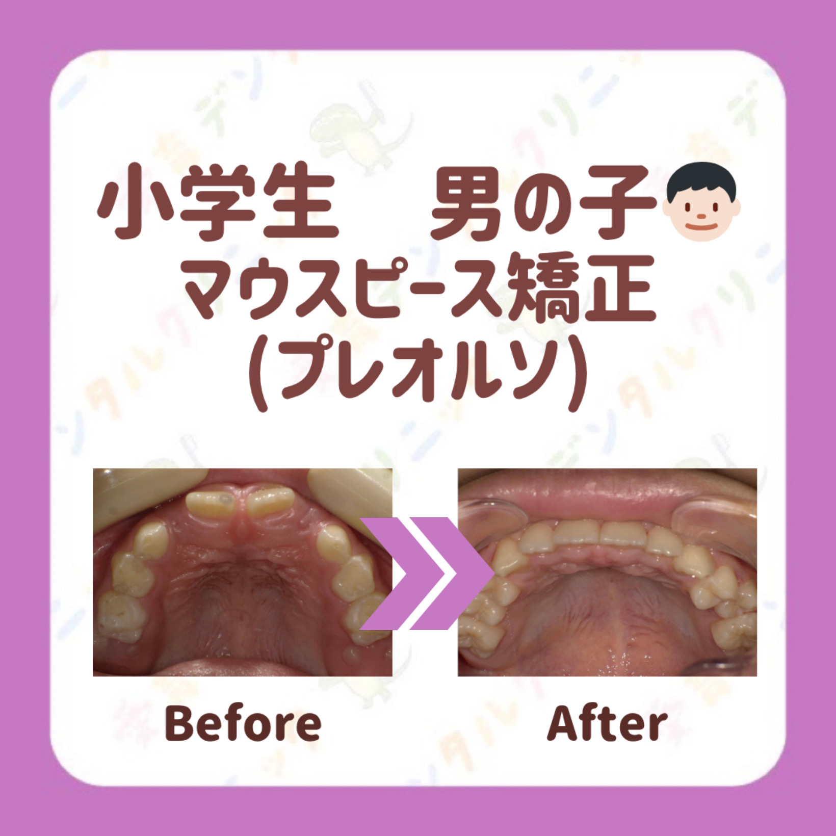 矯正症例