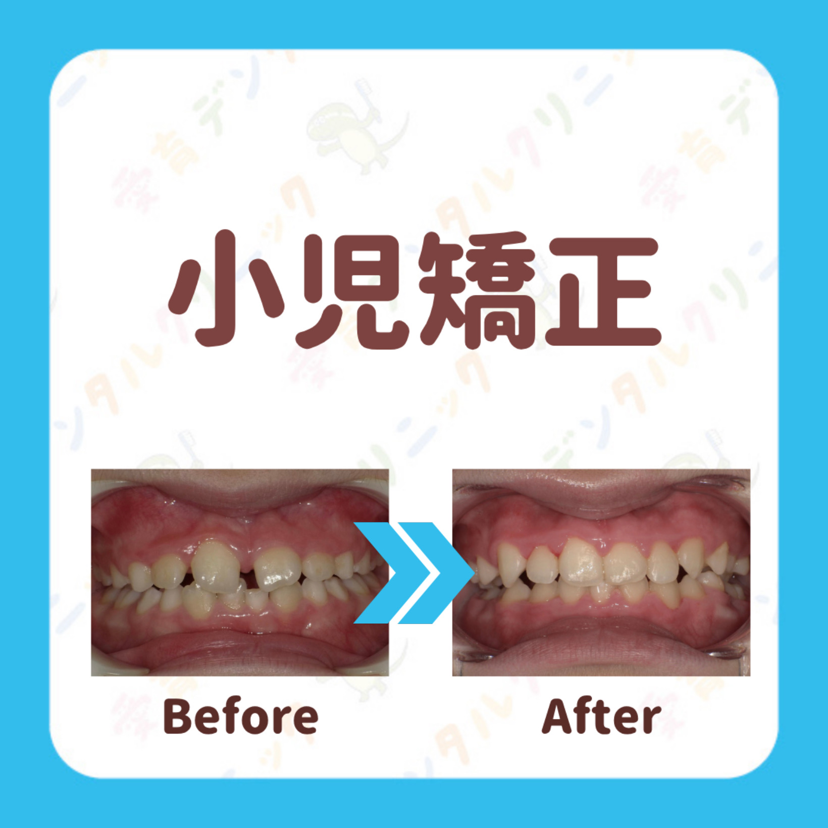 矯正症例