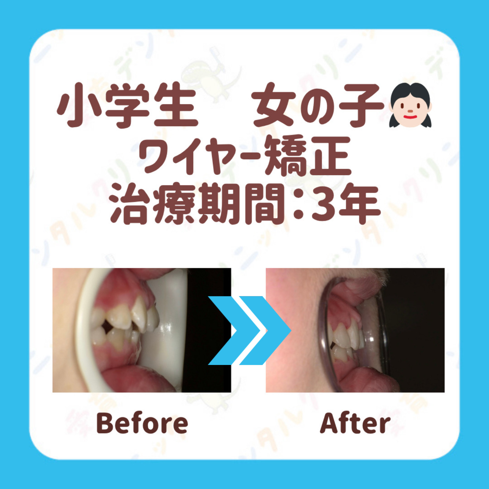 矯正症例