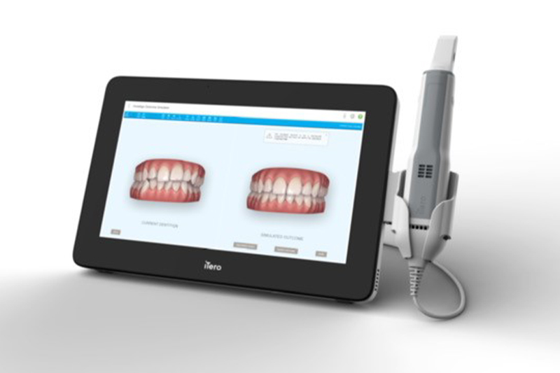 3D光学スキャナー「iTero(アイテロ)」の導入で正確に歯型を採取